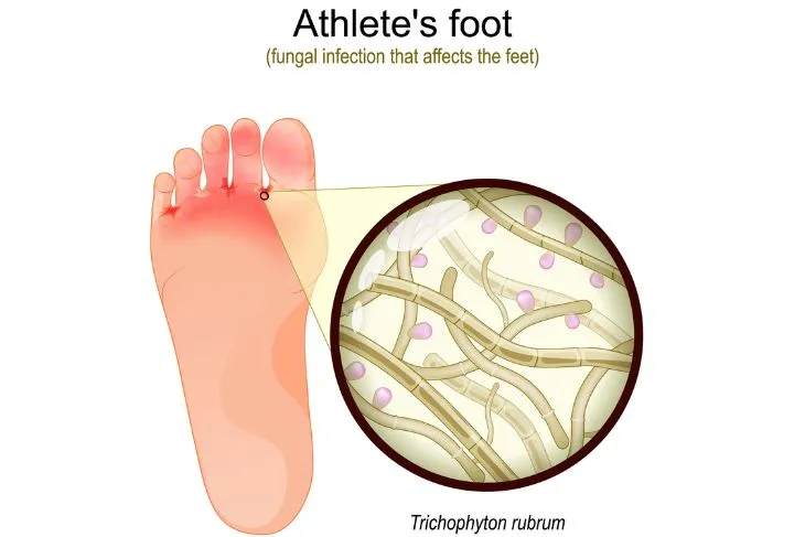 Athlete's Foot: Causes, Symptoms, and Diagnosis