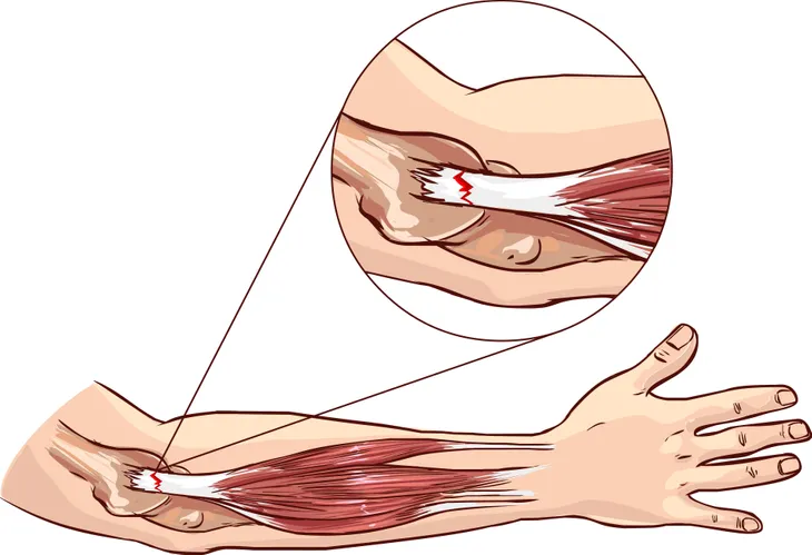 Causes des sensations d'engourdissement et de fourmillement dans ...