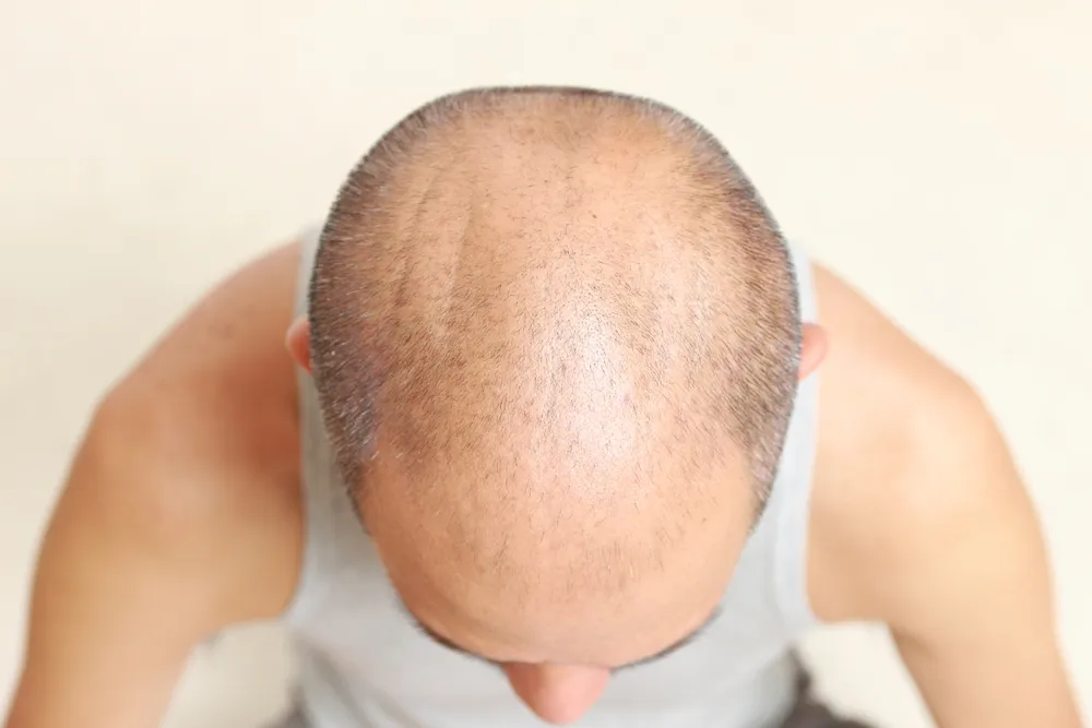 Plucking Hairs Could Stimulate Hair Growth