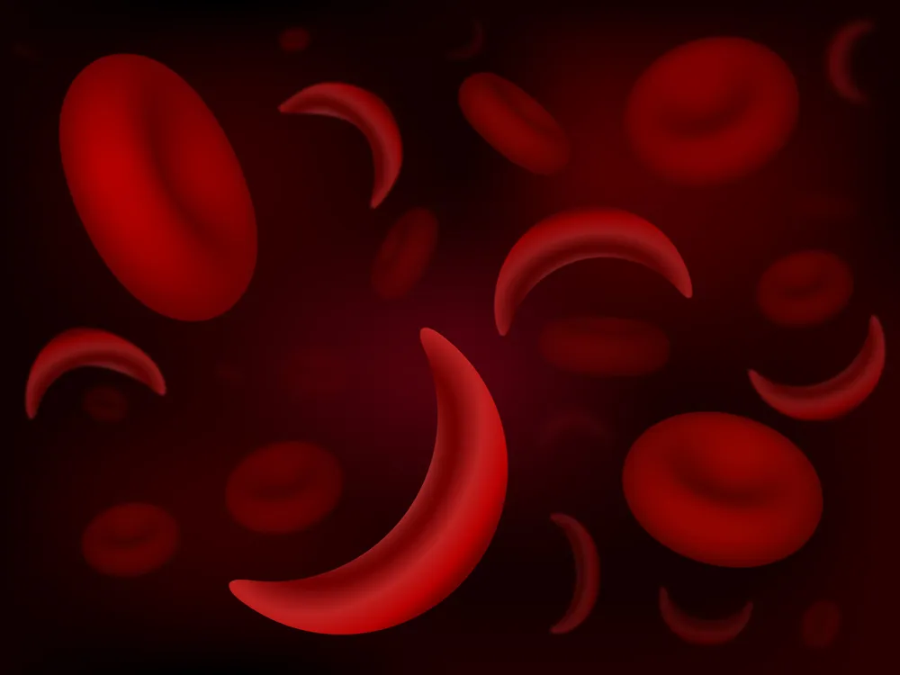 What to Know About Sickle Cell Anemia