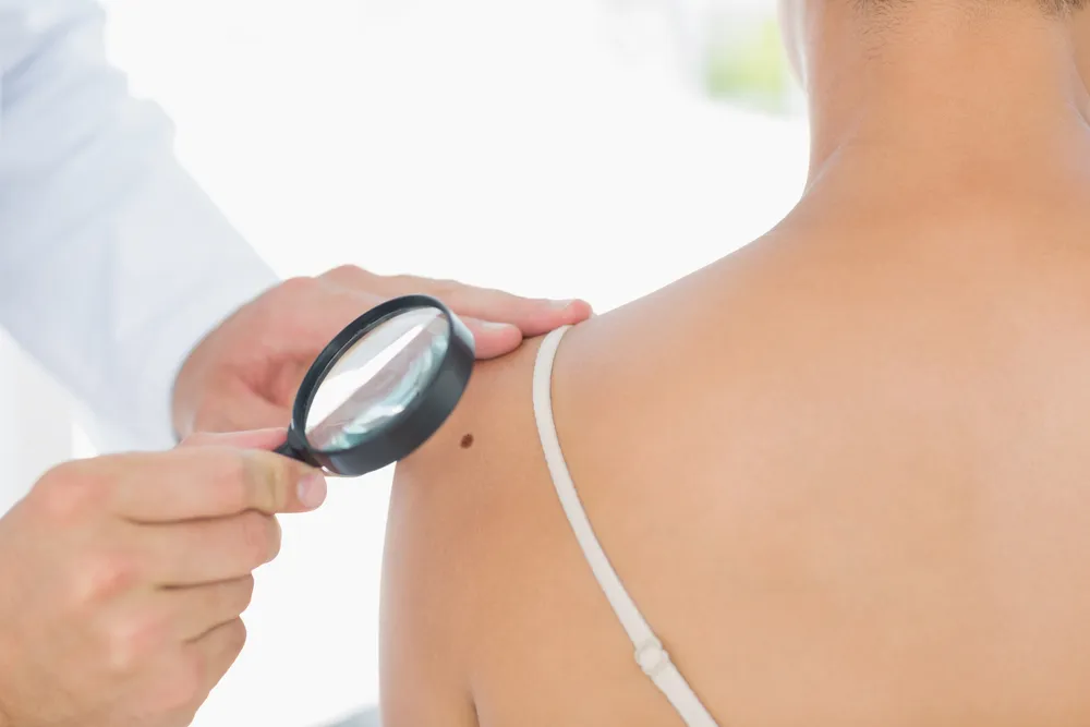 Melanoma Rates Skyrocketing, New Report Suggests