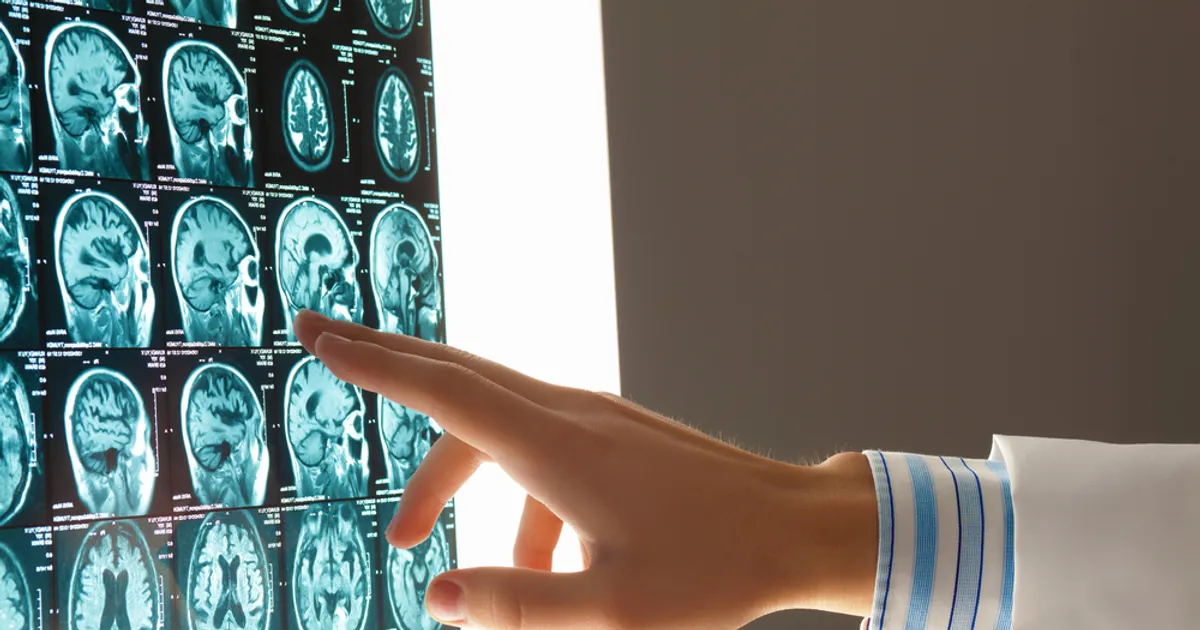 Let's Talk About Traumatic Brain Injury - ActiveBeat - Your Daily Dose
