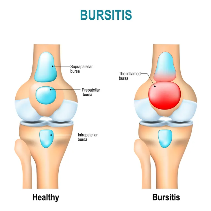 Symptoms, Causes, and Treatment Options of Bursitis – ActiveBeat