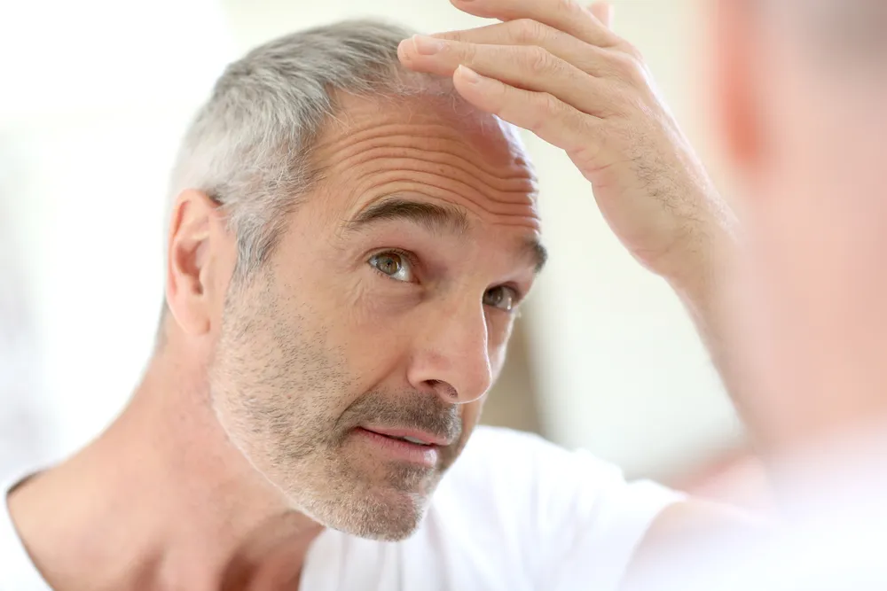 Top Causes of Hair Loss in Men