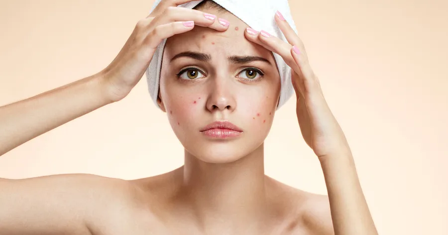 10 traitements topiques pour l’acné