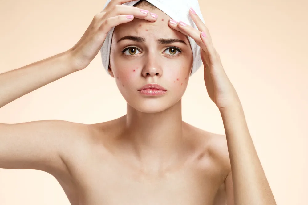 Topical Treatments for Acne