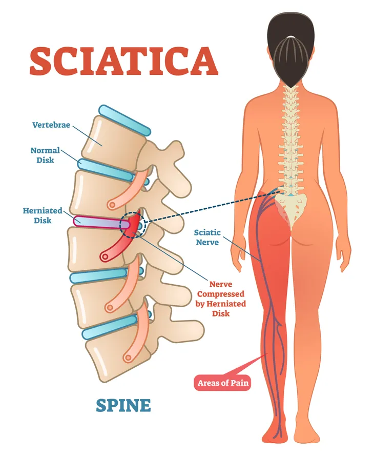 SCIATICA AND LEG WEAKNESS: A WORRYING COMBO