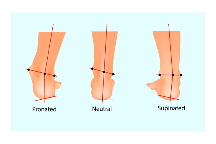 Excessive Supination Treatment Near Me