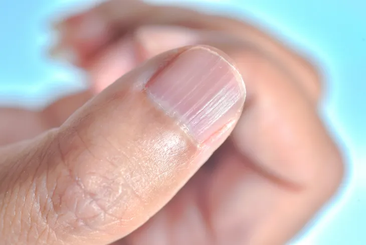 arsenic poisoning fingernail signs