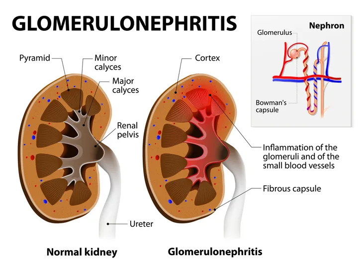 11 Signs and Symptoms of a Kidney Infection – ActiveBeat – Your Daily Dose  of Health Headlines