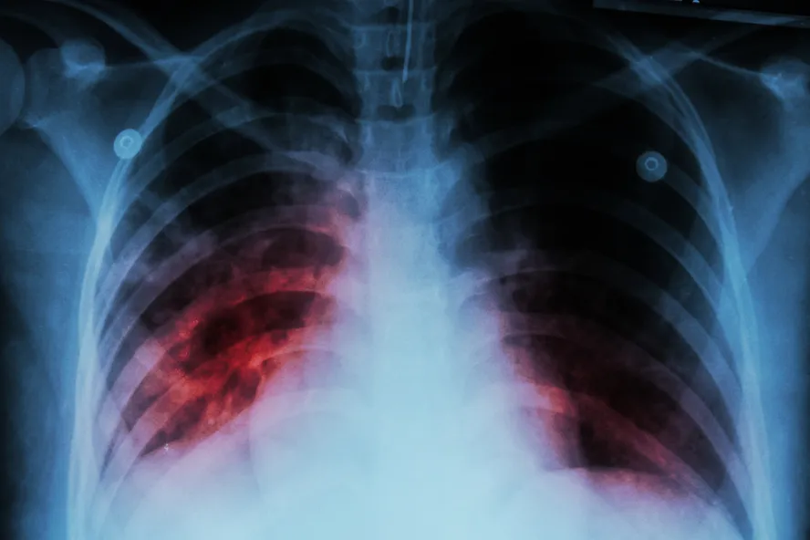 8 faits peu connus sur la tuberculose