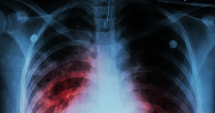 Ocho datos menos conocidos acerca de la tuberculosis