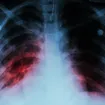 8 Little-Known Facts About Tuberculosis