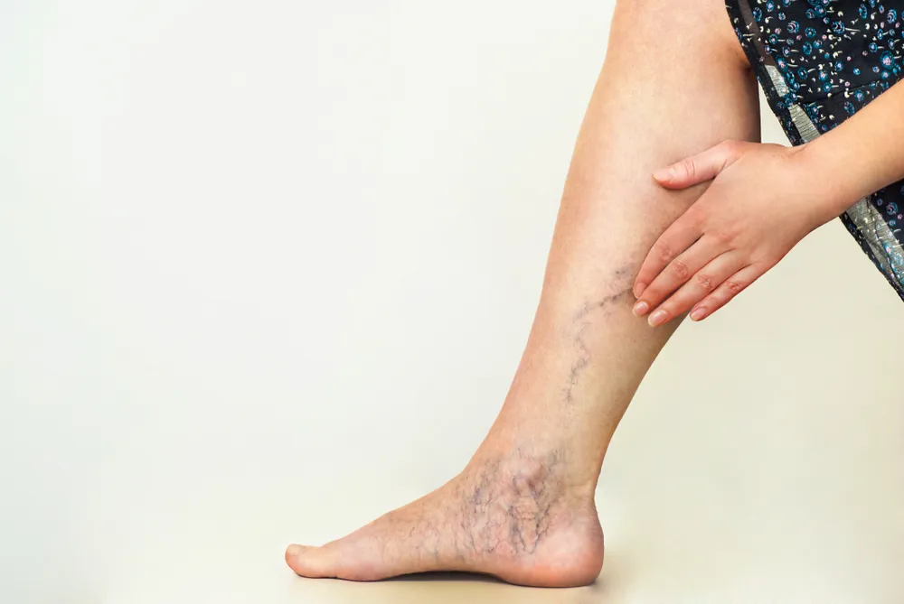 10 Ways to Eliminate Varicose Veins