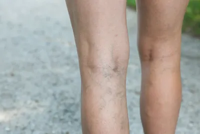 spider vericose veins