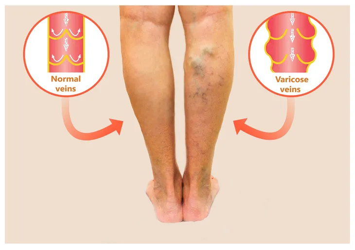 How to Prevent Varicose Veins From Reoccurring