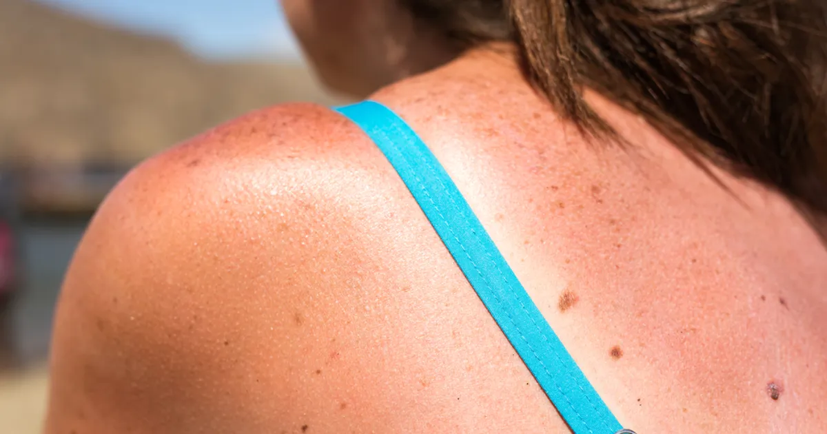 Factors That Increase Your Risk of Skin Cancer ActiveBeat Your