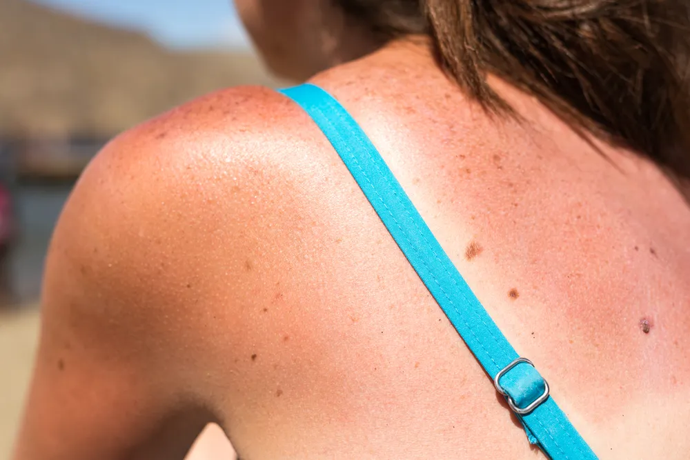 Factors That Increase Your Risk of Skin Cancer