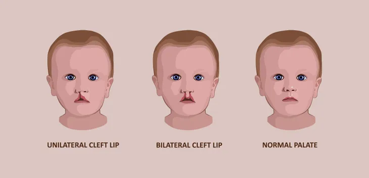 bilateral cleft palate