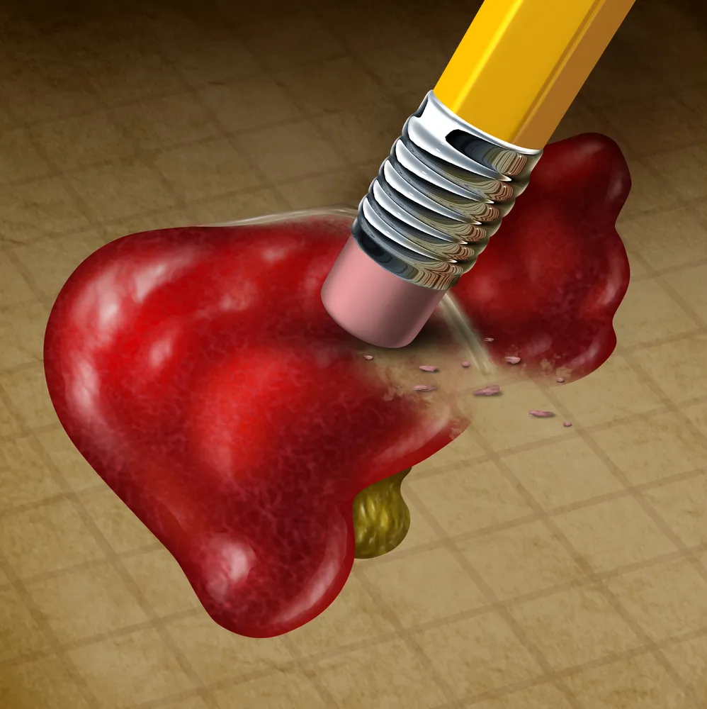 6 Medical Facts on Primary Biliary Cholangitis