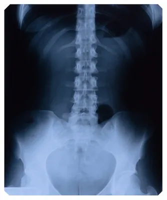 spine xray