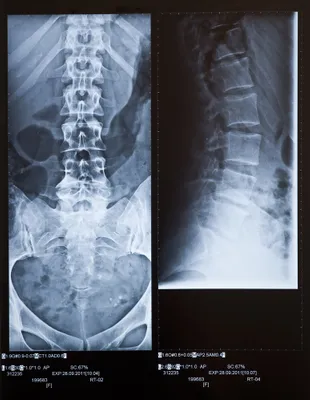 spinal curvature