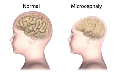 microcephaly