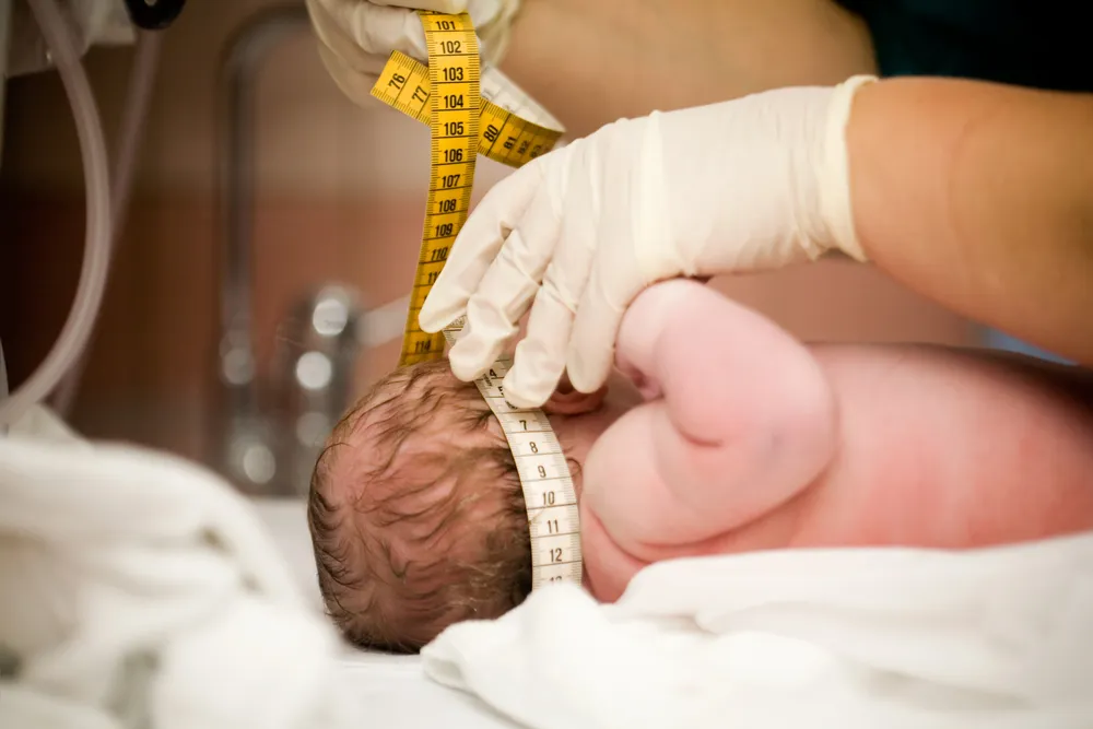 6 Medical Facts on Microcephaly