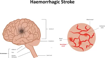 hemorrhagic stroke