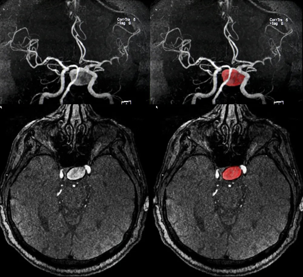 7 Key Differences And Similarities Of Strokes And Aneurysms Activebeat Your Daily Dose Of