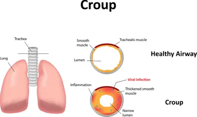 croup