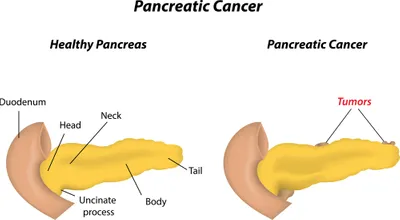 pancreatic cancer