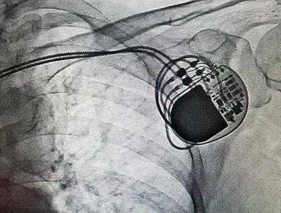 cardiac catheterization