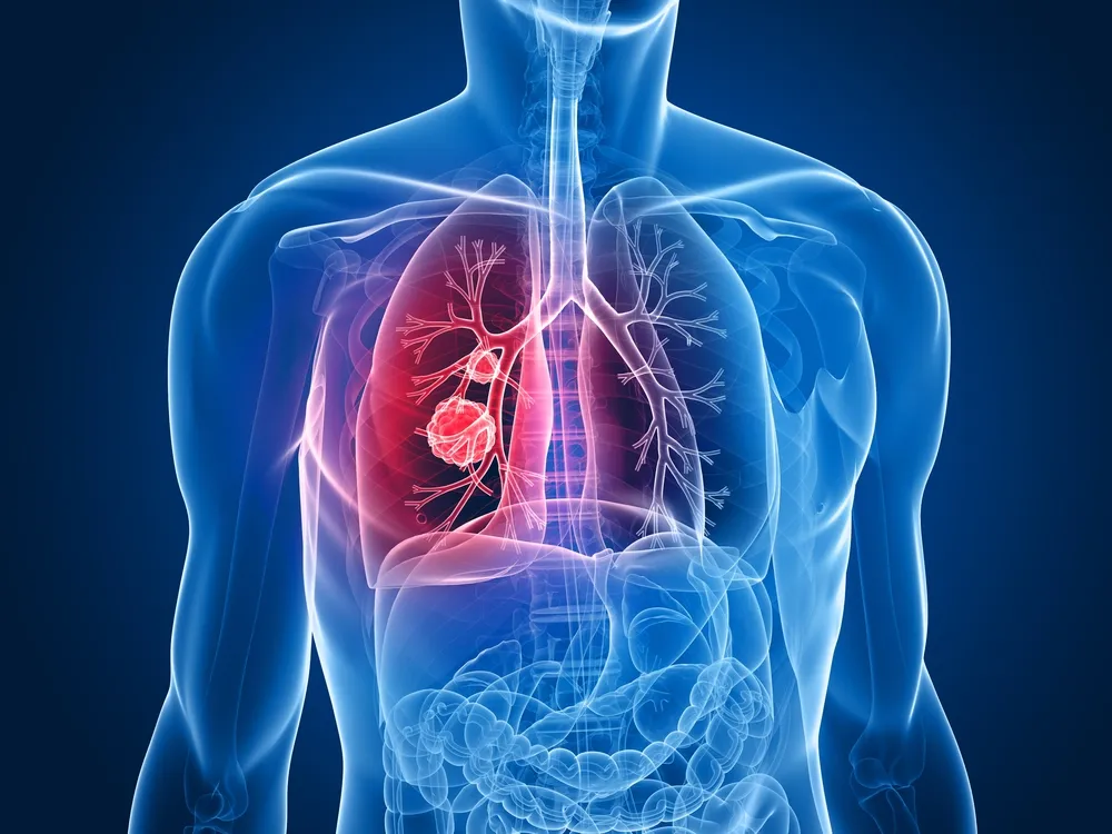 Targeted Therapies for Lung Cancer