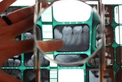 tooth dental xray