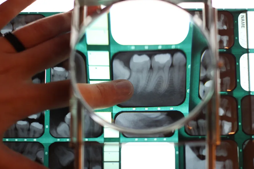 6 Facts That Get to the Root of Tooth Resorption