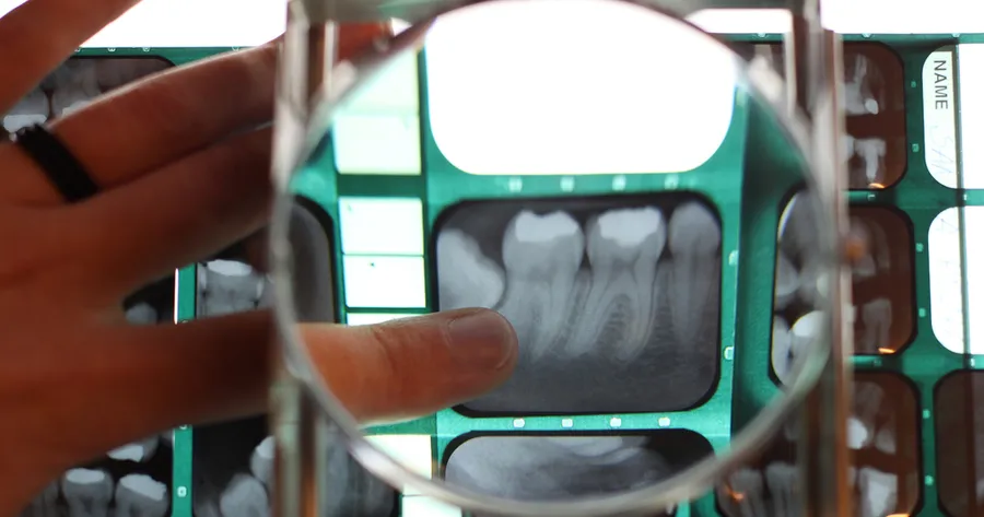 6 Facts That Get to the Root of Tooth Resorption