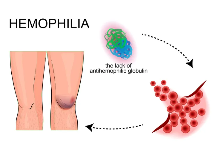 Facts on Hemophilia and Inherited Bleeding Disorders – ActiveBeat – Your  Daily Dose of Health Headlines