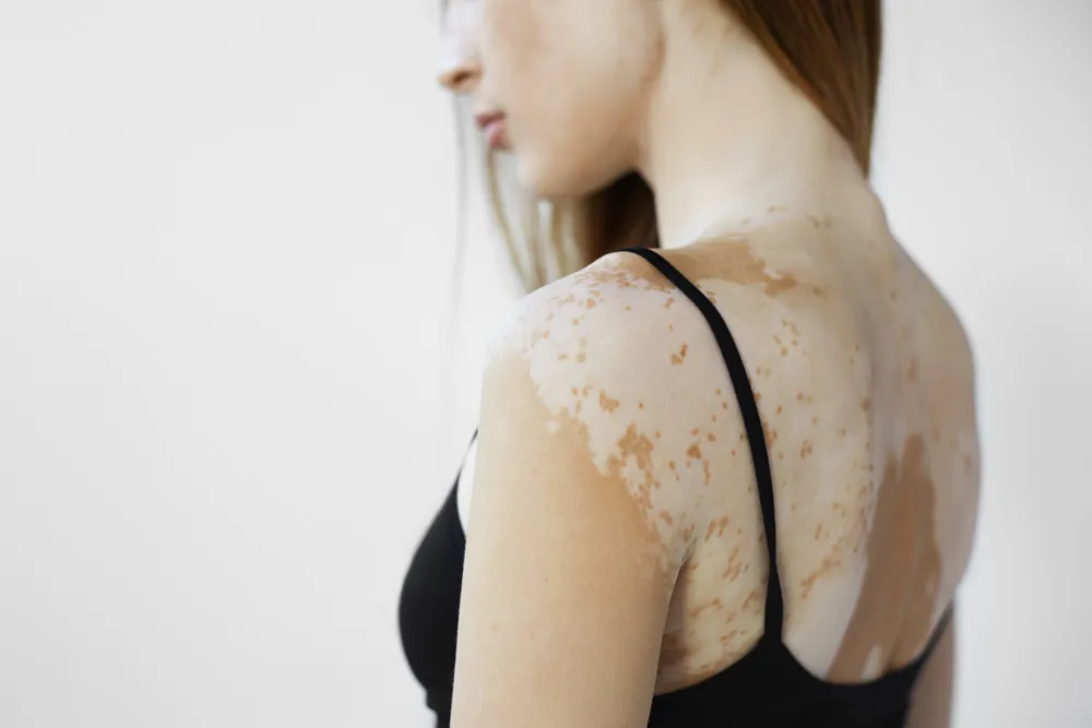 Treatment Options for Vitiligo