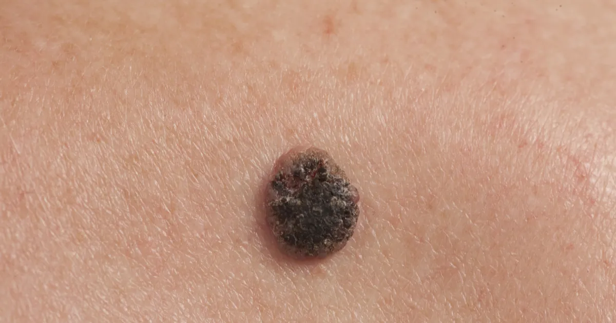 Squamous Cell Skin Cancer: Signs, Symptoms, and Treatment - ActiveBeat ...