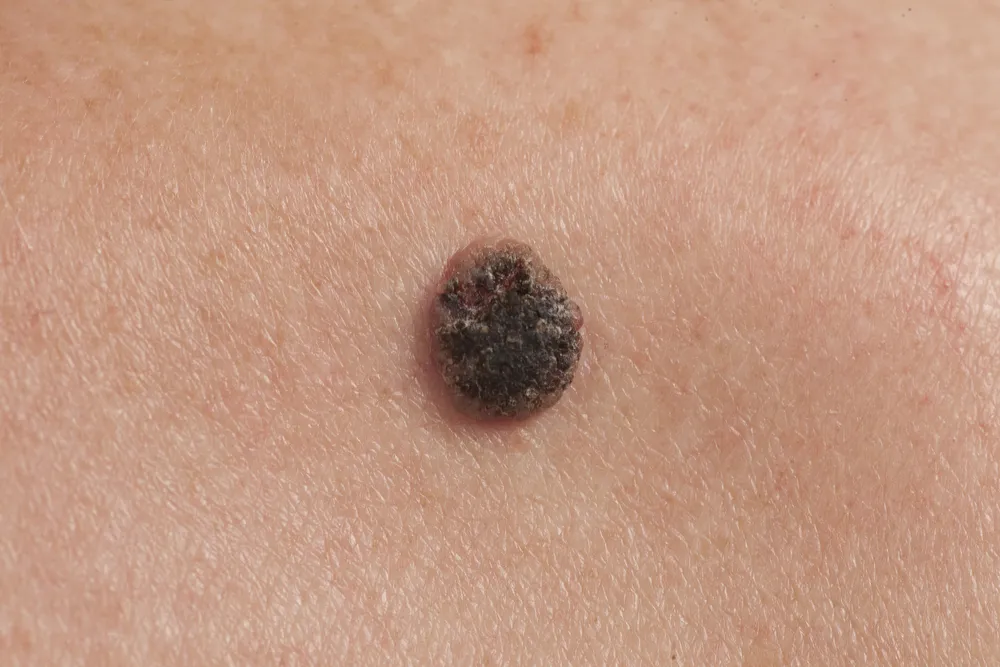 Squamous Cell Skin Cancer: Signs, Symptoms, and Treatment