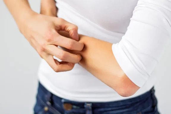 Plaque Psoriasis: Signs, Causes, and Treatment Options