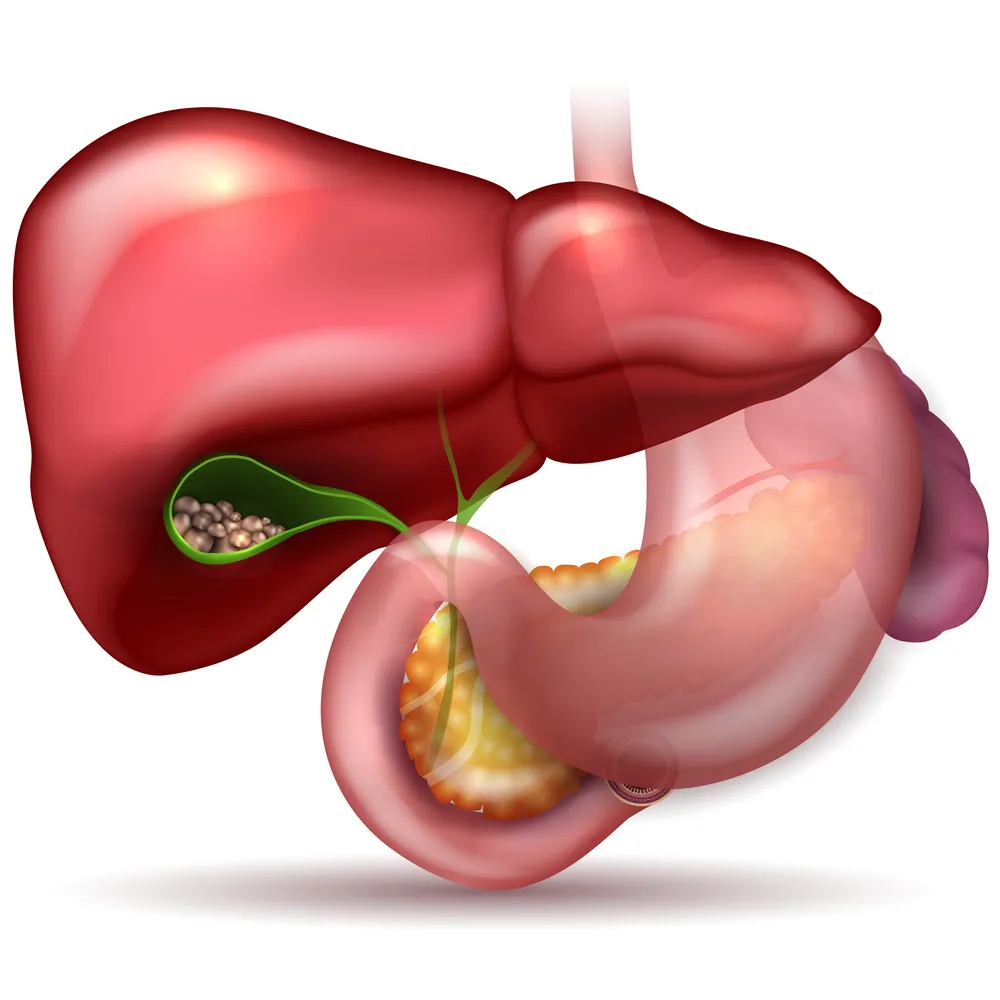 Common Causes of Gallstones