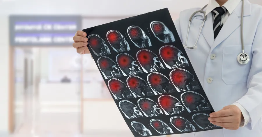 13 sinais de alerta de um tumor cerebral que você não deve ignorar