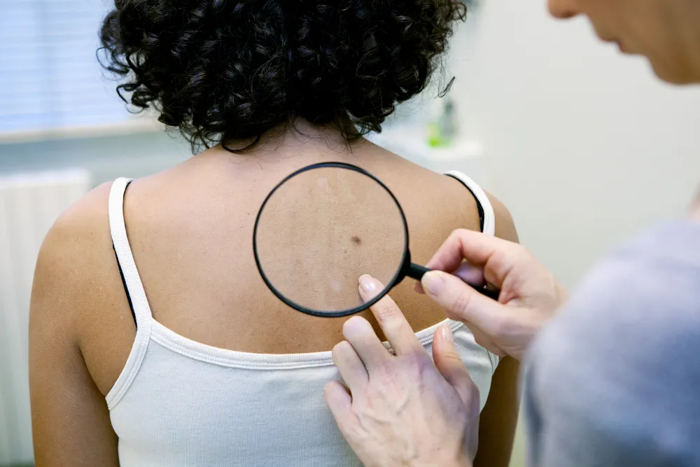 Skin Cancer Symptoms That are More Than Skin Deep