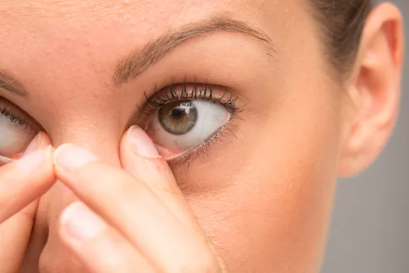 Things to Know About a Stye: Causes and Treatments