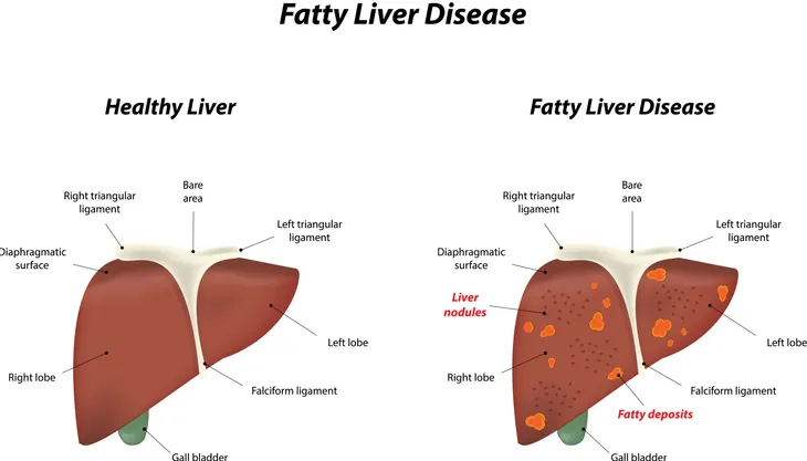 fatty liver and normal liver