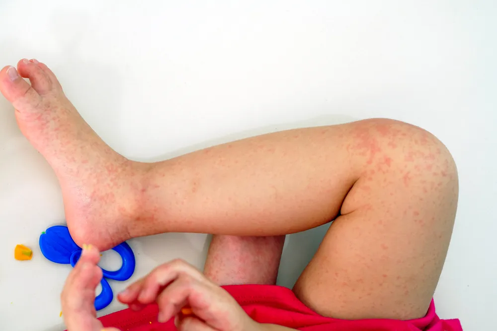 What to Know About Roseola