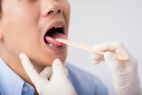 Glossitis: What to Know About Inflammation of the Tongue