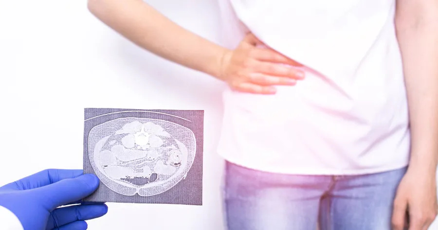 20 sintomas comuns que levam à apendicite